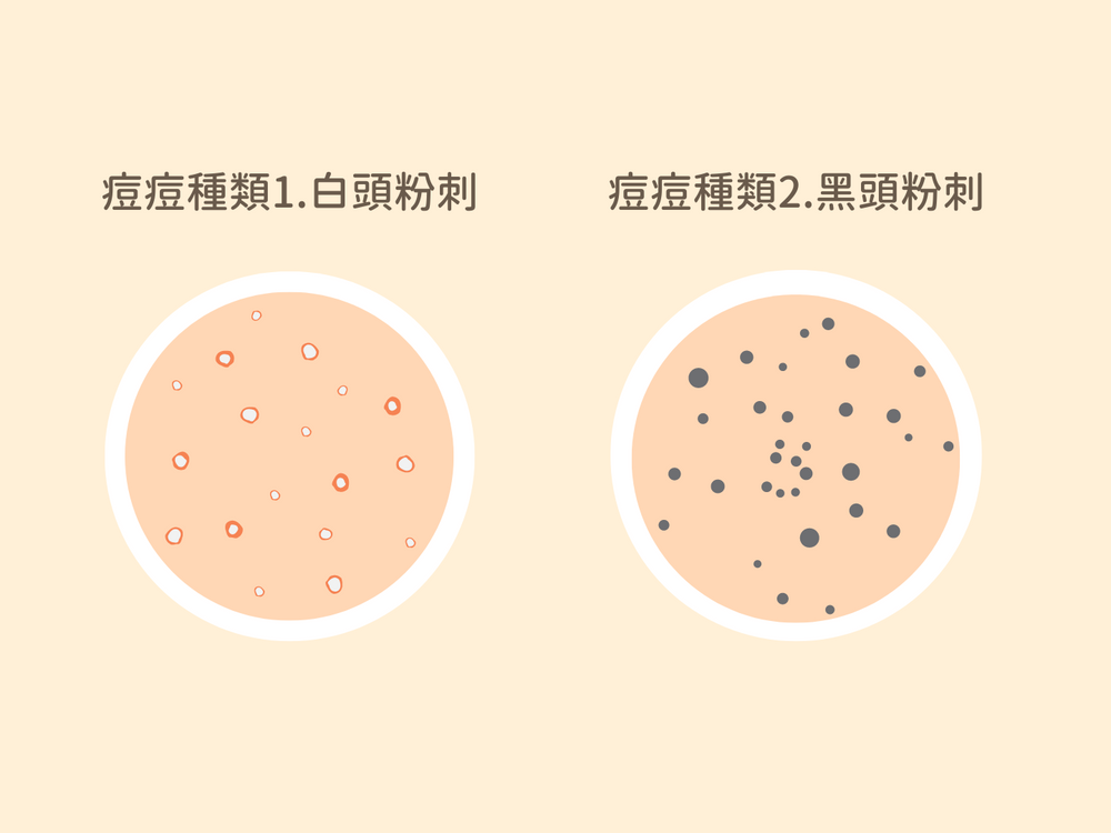 抗痘戰士集合！5點了解粉刺、痘痘種類：閉鎖性粉刺、囊腫型痘痘...，加碼2023抗痘保養品推薦，控油、清毛孔有感！-3