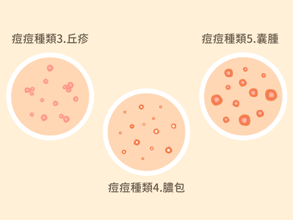 抗痘戰士集合！5點了解粉刺、痘痘種類：閉鎖性粉刺、囊腫型痘痘...，加碼2023抗痘保養品推薦，控油、清毛孔有感！-4