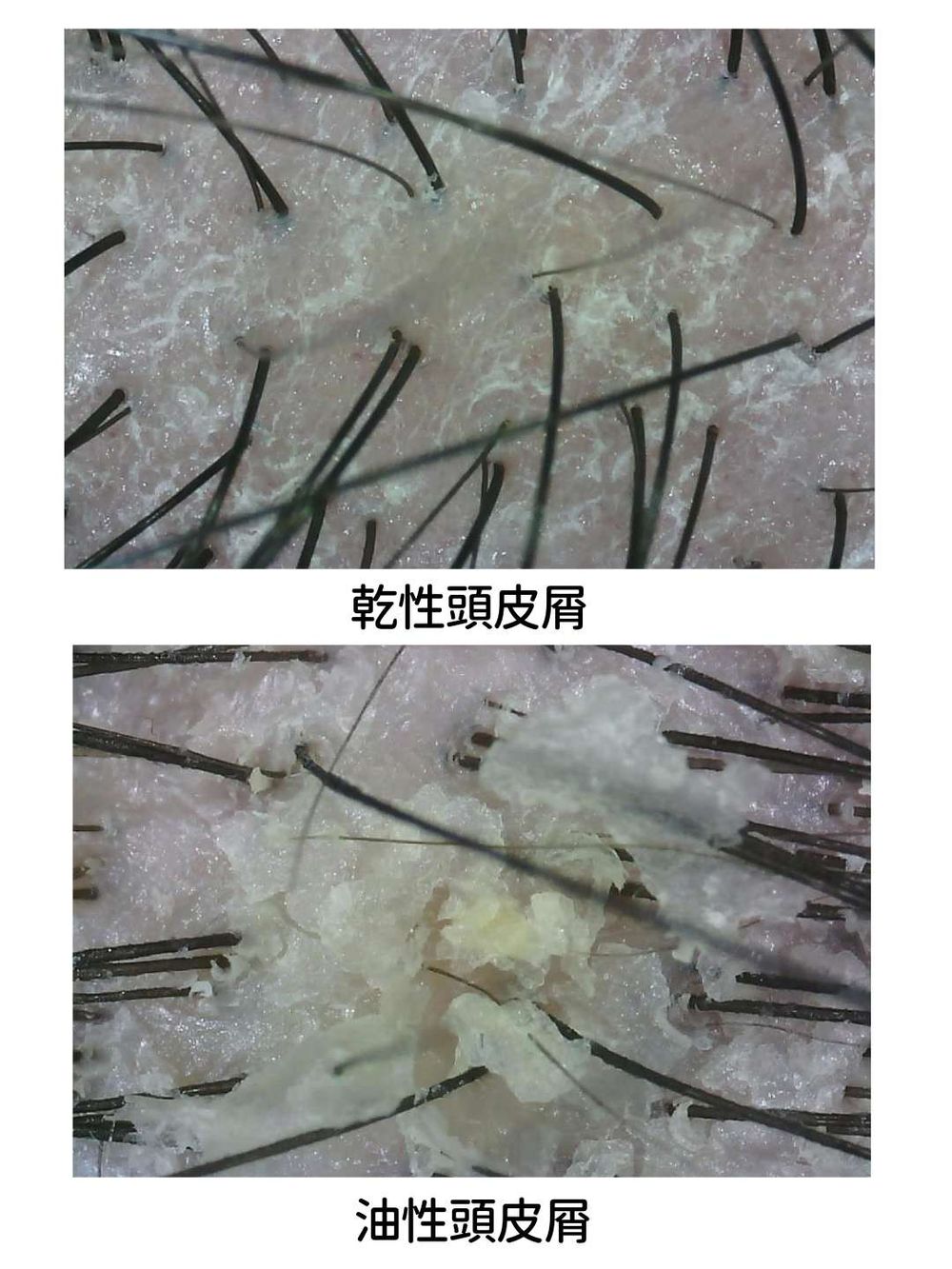 史上最強淨屑王者降臨！解決頭皮問題專家「艾瑪絲」，全新推出植萃無藥速屑洗髮精，油乾頭皮屑問題一次到位！-12