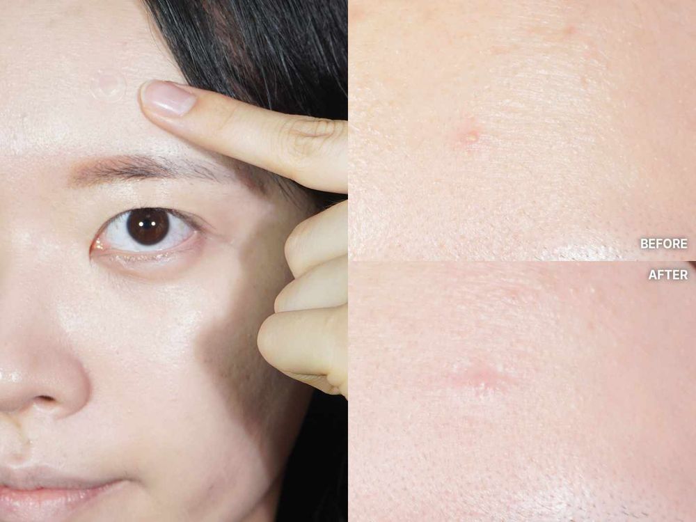 痘痘貼正確用法公開！哪種痘痘適合貼？妝前「這樣貼」超隱形...，美妝版大推人氣痘痘貼推薦！-5