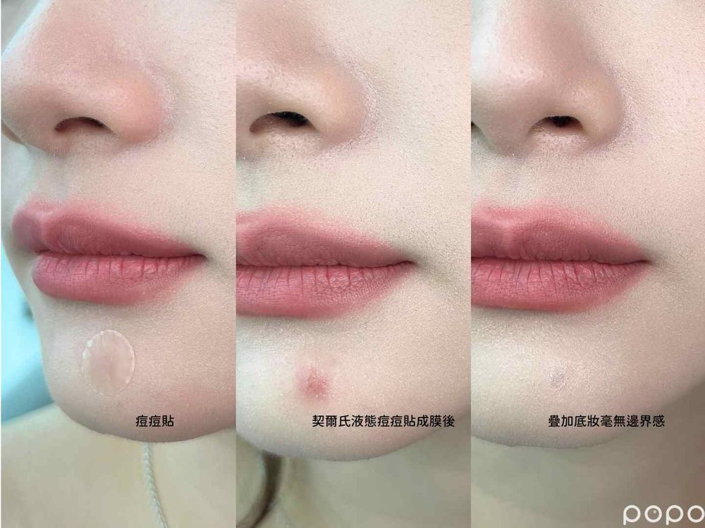 痘痘貼正確用法公開！哪種痘痘適合貼？妝前「這樣貼」超隱形...，美妝版大推人氣痘痘貼推薦！-19