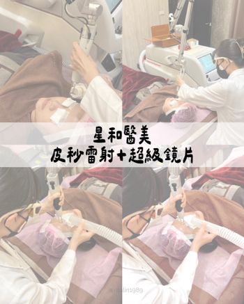 ♡星采星和醫美♡皮秒雷射+超級鏡片 紀錄📝