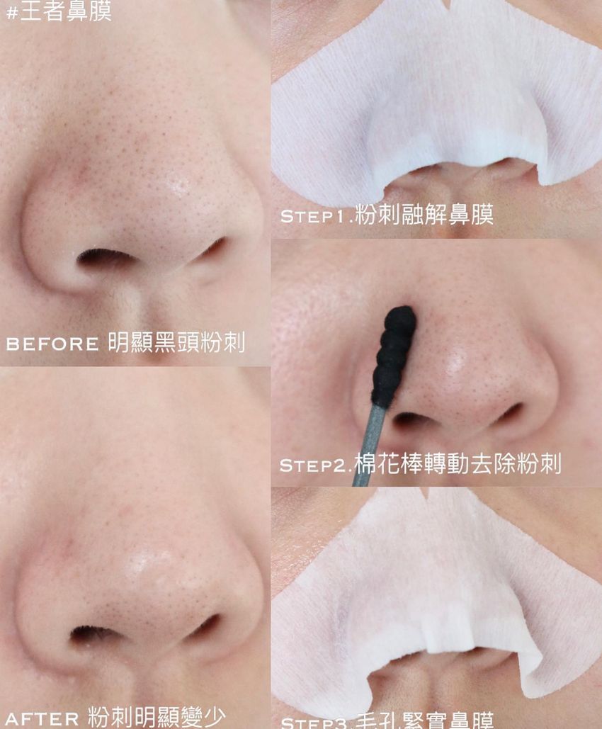 網友零負評開架抗痘保養推薦！韓國賣爆粉刺鼻膜、敏弱肌最愛溫和煥膚精華液...，這款根本是痘痘剋星！-16